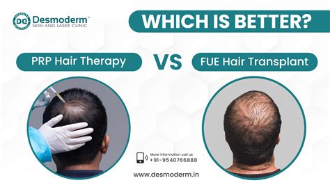 Hair Transplant vs. Other Hair Loss Treatments: Pros and Cons